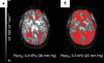 Tomografia computerizată în accident vascular cerebral