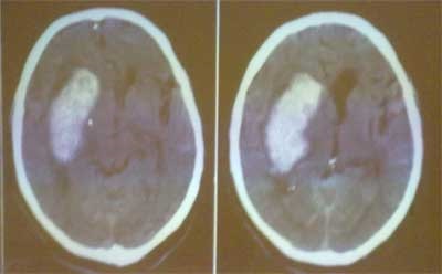 Tomografia computerizată în accident vascular cerebral