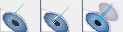 Corecția cu laser a astigmatismului - centrul operației oculare