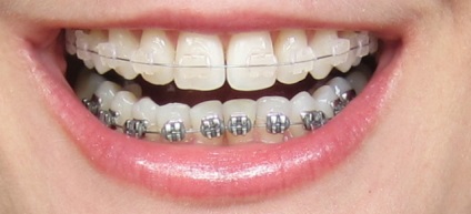 Laser stomatologie - alinierea dinților