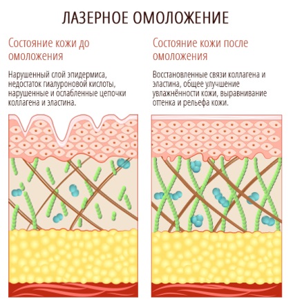 Лазерно подмладяване на вида и ефективността