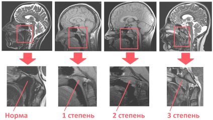 orrpolip kezelésére, műtét nélkül Moszkvában a gyermekek és felnőttek, lézeres kezelés orrpolip