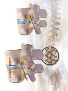 Tratamentul herniei spinal folk remedii fără simptome chirurgicale, decocții și infuzii, utilizarea de