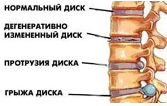 nyúlványát a porckorong kezelésére Moszkva árak, az online kinevezések