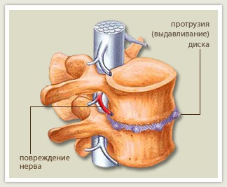 Tratamentul proeminenței discului intervertebral, clinică a medicului Grigorenko