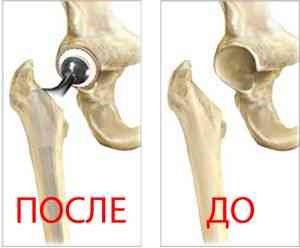 Tratamentul gâtului șoldului - boli ale oaselor și articulațiilor - catalog de articole - rețete medicinale populare