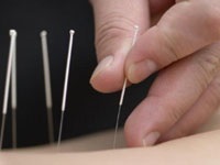 Tratamentul articulațiilor cu acupunctura