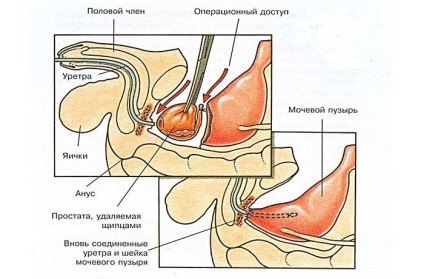 Radioterapia pentru cancerul de prostată (cancer de prostată) - indicații, recenzii, consecințe