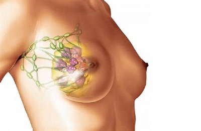 Mastopatia cu simptome de menopauză și tratamentul glandei mamare la menopauză