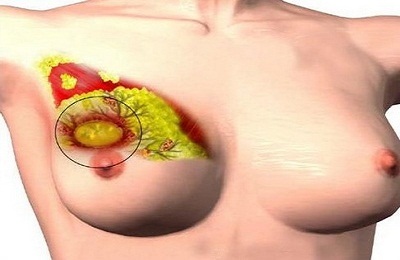 Mastopatia cu simptome de menopauză și tratamentul glandei mamare la menopauză