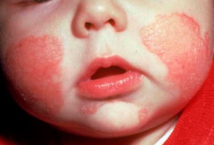 Kenőcs allergiától a gyerekek a bőrön, az arc, a hormonális és nem hormonális krém