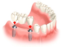 Coroane metalo-ceramice pe implanturi, privat dentist balayan levon gechievich