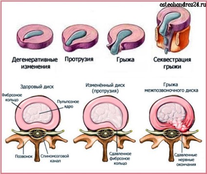 Hernia intervertebrală - trăsături ale bolii și tratament