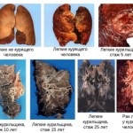 Mumia cu bronșita unui fumător pentru și împotriva lui