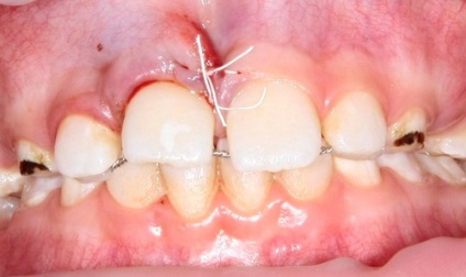 Cusaturi dupa extractia dintelui si alte operatii dentare