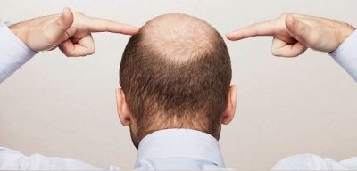 Folk jogorvoslati lehetőségeket a hajhullás a férfiak kezelésben részesülő otthon alopecia a fejét!