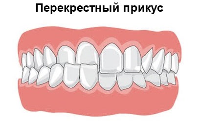 Overbite hogy ez nem okoz elzáródást görbe, hogyan kell meghatározni (ok) Overbite hogy ez nem okoz elzáródást görbe, hogyan lehet azonosítani