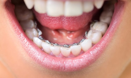 Overbite hogy ez nem okoz elzáródást görbe, hogyan kell meghatározni a (harapás) Overbite hogy ez nem okoz elzáródást görbe, hogyan lehet azonosítani