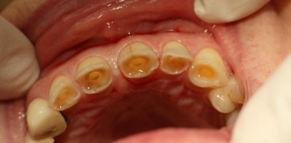 Dentinogenesis imperfecta szindróma Stanton-kapdepona és amelogenesis