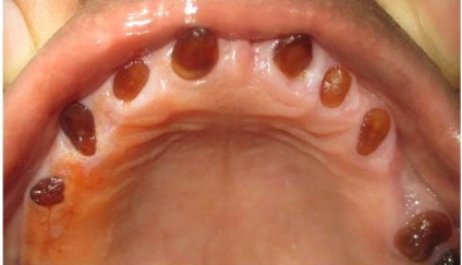 Dentinogenesis imperfecta szindróma Stanton-kapdepona és amelogenesis