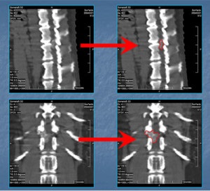 Neurinomul metodelor de tratament ale coloanei vertebrale, chirurgie, perioada postoperatorie