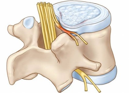 Neurinomul coloanei vertebrale de ce se dezvoltă boala