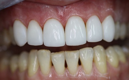 Despre restaurarea dinților anteriori