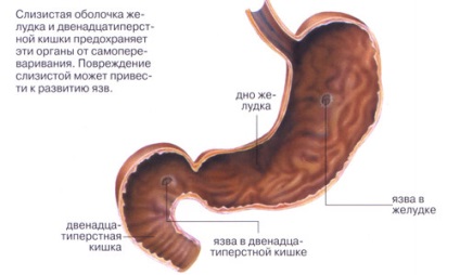 Complicațiile ulcerului gastric