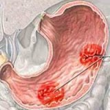 Complicații ale ulcerului gastric - bisturiu - informații medicale și portal educațional