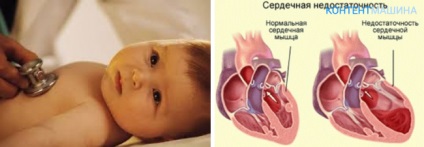 Insuficiență cardiacă acută la copii