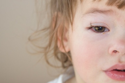 Umflarea feței și ochilor copiilor ca simptome ale diferitelor boli