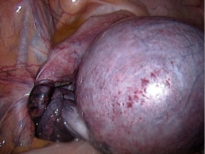 Torsionarea picioarelor tumorilor din anexele uterine