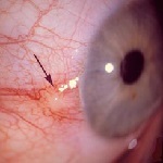 Ochii Pengwekula și tratamentul ei (intervenția chirurgicală pentru îndepărtarea și picurarea)