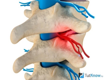 Coloana vertebrală a unui atlet ce să facă cu trauma