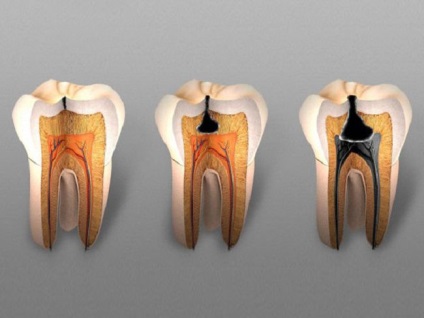 Cauzele cariilor, simptomele și tratamentul acestora