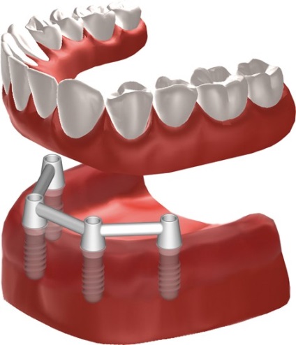 Proteze implantate - prețul protezelor detașabile pe implanturi în absența totală