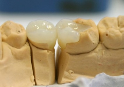 Kerámia fogtechnikai előnyei kerámia pótlások