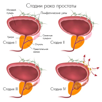 Prevenirea, simptomatologia și prognosticul cancerului de prostată