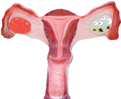 Cancerul ovarian la femei
