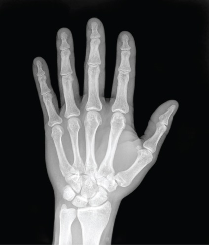 Stretch al ligamentului mâinii - simptome și tratament
