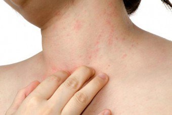 Dermatite cauzate de soare, simptome, tratament cu remedii folclorice