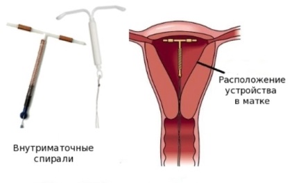 Spiral după naștere, atunci când este posibil să se pună, a pus acolo, ce mai bine contraceptiv intrauterin,