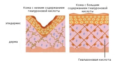 Pentru a elimina pliurile nazolabiale cu acid hialuronic, prețul medicamentelor și al serviciilor