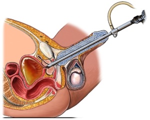 Eliminarea adenomului prostatic - metode de tratament a bolii