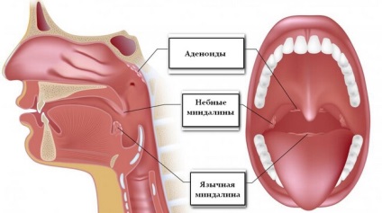 Îndepărtarea amigdalelor în amigdalită cronică, amigdalectomie