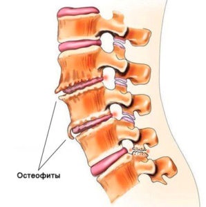 Unkovertebralny osteoarthritis a nyaki gerinc, a tünetek, a kezelés