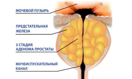 Exerciții fizice în exerciții fizice și masaj de adenom de prostată