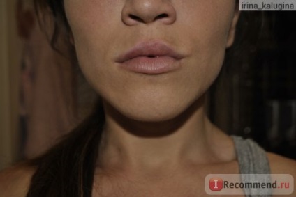 Creșterea buzelor cu ajutorul preparării acidului hialuronic - 