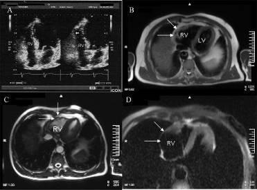 Ventriculografia, tomografia computerizată (CT) a inimii - rolul angiografiei coronare, aortografiei,
