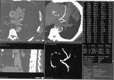 Ventriculografia, tomografia computerizată (CT) a inimii - rolul angiografiei coronare, aortografiei,